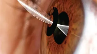 Corrección de la presbicia mediante el implante KAMRA